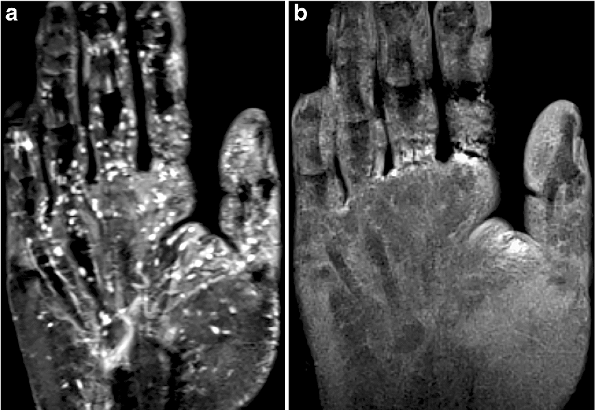 MRI scan of the Pacinian corpuscles in a corpse